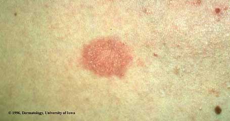 Pityriasis Rosea1.jpg