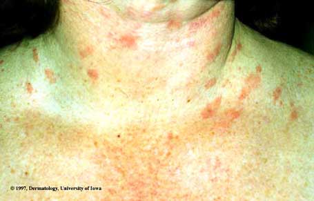 Pityriasis Rosea3.jpg