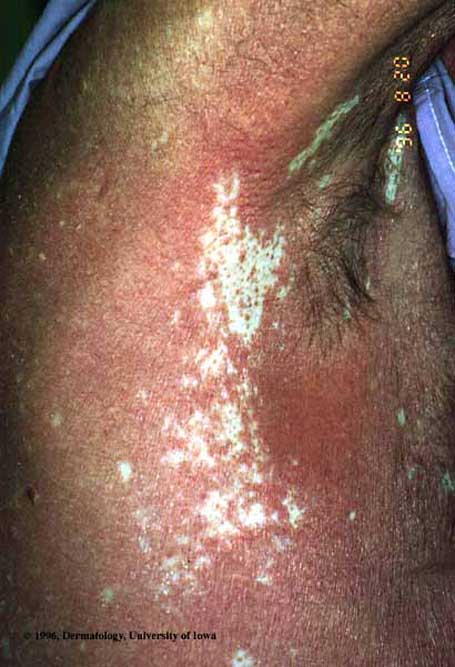 Pityriasis Rubra Pilaris.jpg