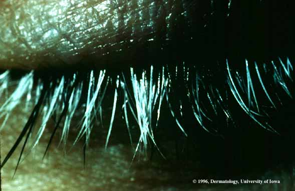 Poliosis in Vogt-Koyangi-Harada Syndrome.jpg