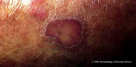 Porokeratosis of Mibelli.jpg