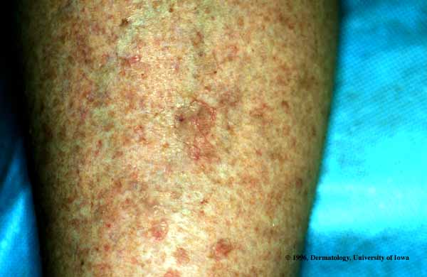 Porokeratosis- Disseminated Superficial Actinic.jpg