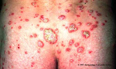 Psoriasis2.jpg