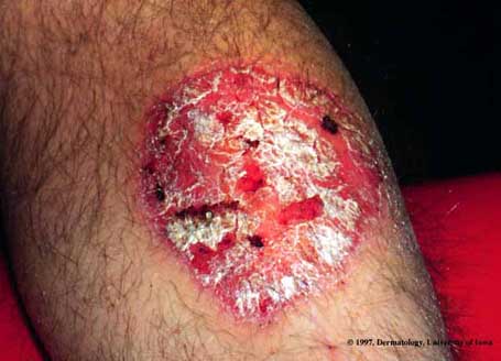 Psoriasis3.jpg