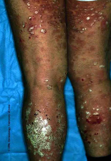 Psoriasis5.jpg