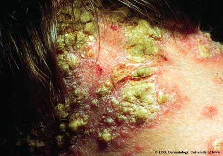 Psoriasis9.jpg