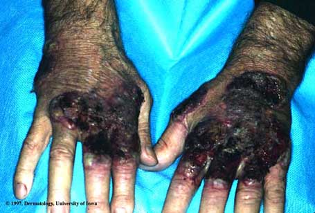 Pyoderma Gangrenosum.jpg