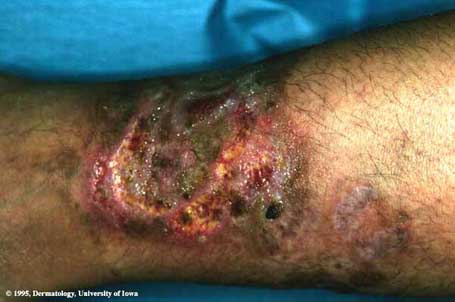 Pyoderma Gangrenosum2.jpg