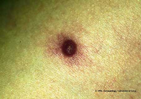 Pyogenic Granuloma.jpg