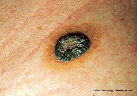 Seborrheic Keratosis.jpg