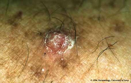 Squamous Cell Carcinoma.jpg