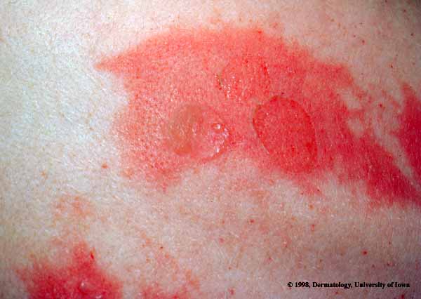 Staphylococcal Scalded Skin Syndrome.jpg