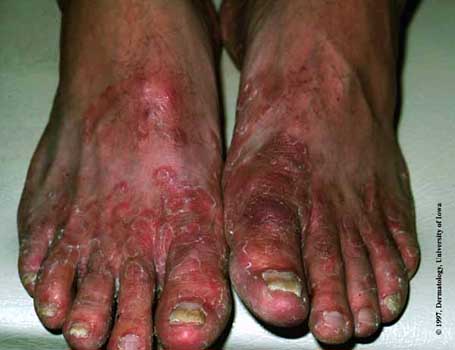 Tinea Pedis1.jpg