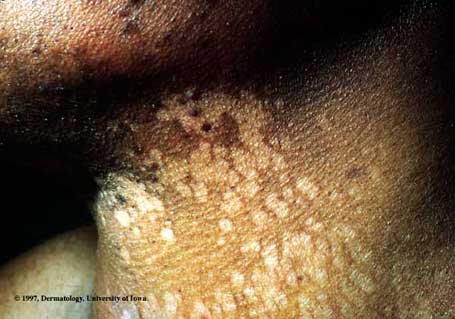 Tinea Versicolor.jpg