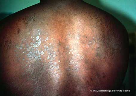 Tinea Versicolor2.jpg