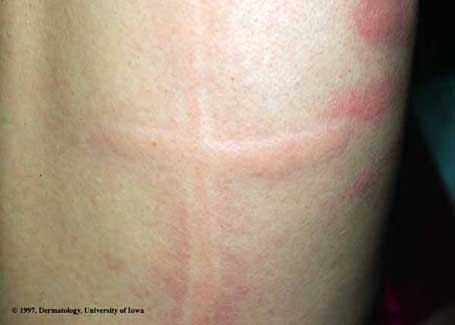 Urticaria- Cold Induced2.jpg