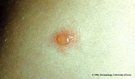 Varicella Infection1.jpg