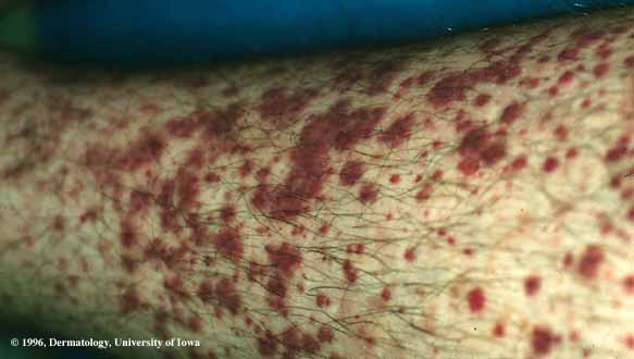 Vasculitis- henoch-Schonlein Purpura.jpg