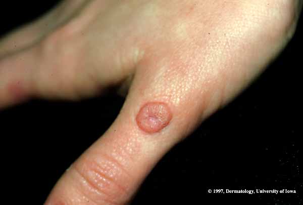 Wart-02.jpg