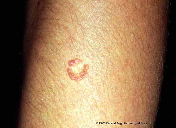 Wart-03.jpg