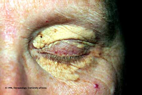 Xanthelasma.jpg