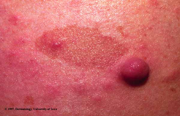 von Recklinghausen's Disease1.jpg