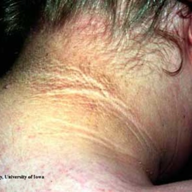 Acanthosis Nigricans