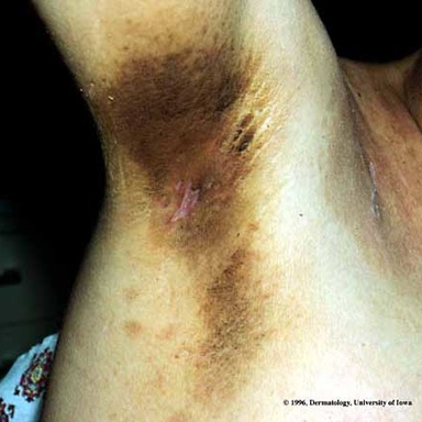 Acanthosis Nigricans
